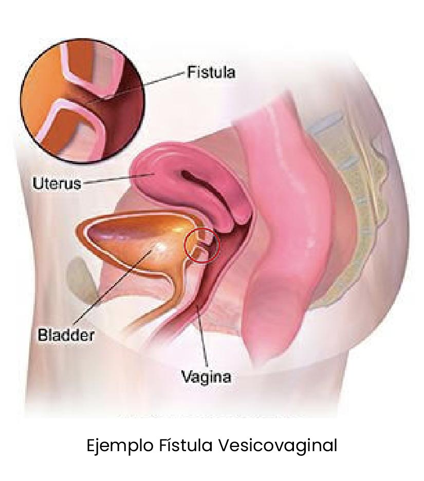 Fístula Vesicovaginal